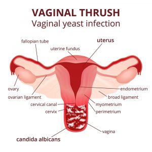  how to get rid of a yeast infection in 24 hours