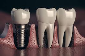 Osseointegration Implants Market Growth, Share, Opportunities & Competitive Analysis, 2024 – 2032