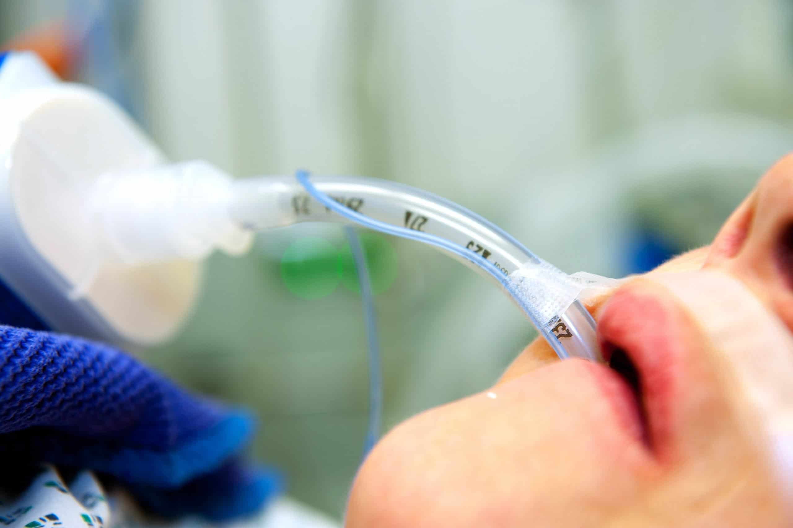 Tracheal Tube and Airway Products Market Growth, Share, Opportunities & Competitive Analysis, 2024 – 2032