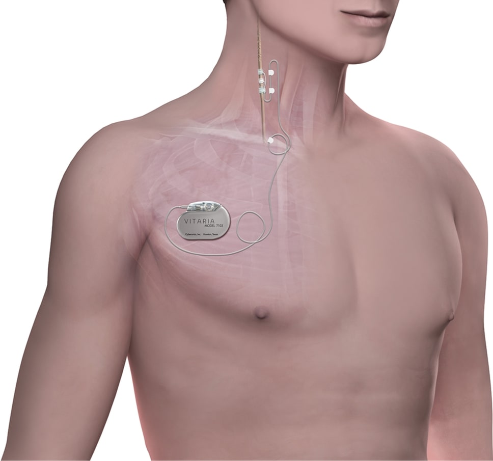 Vagus Nerve Stimulator Market Growth, Share, Opportunities & Competitive Analysis, 2024 – 2032